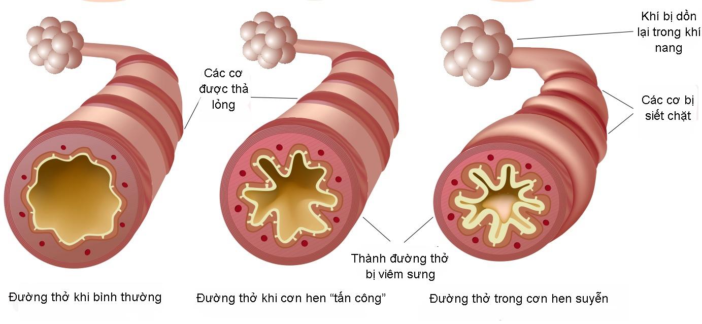 Bệnh Hen Suyễn Có Di Truyền Không?