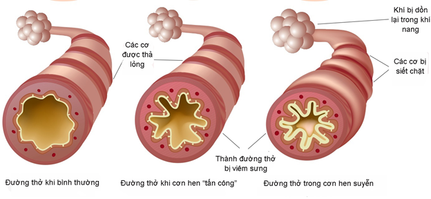 3. Các Yếu Tố Ảnh Hưởng Đến Bệnh Hen Suyễn