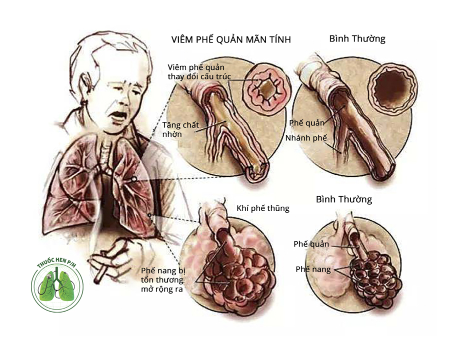 Triệu chứng chính của bệnh phổi tắc nghẽn mạn tính là gì?

