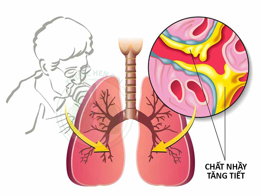 Phổi khò khè: Nguyên nhân, triệu chứng và cách điều trị hiệu quả