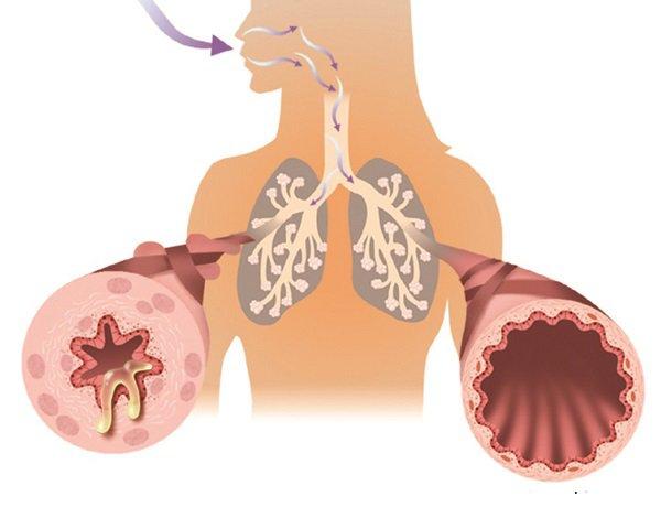 Nguyên nhân gây ra suyễn bội nhiễm là gì?
